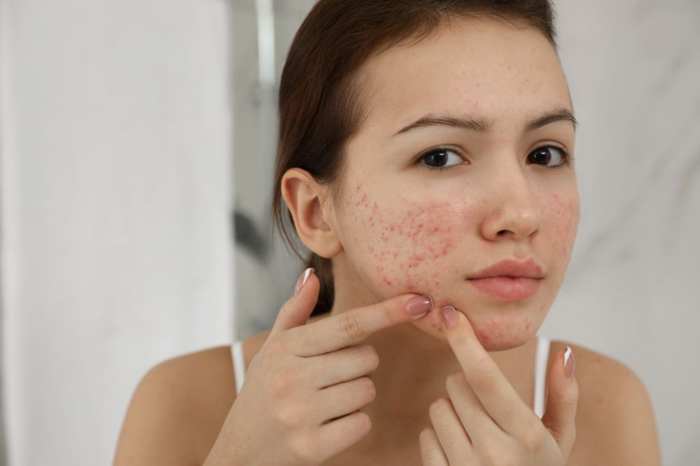 Acne Treatment | Dubai Dermatology Clinic