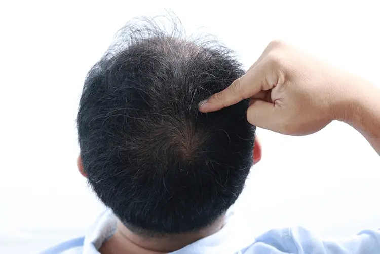 Alopecia Areata Treatment Dubai