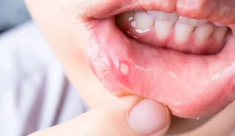 Aphthous Ulcers (Canker Sores)