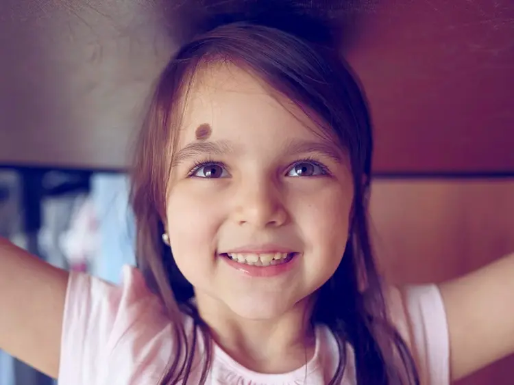 Birthmarks and Hemangiomas Treatment Dubai