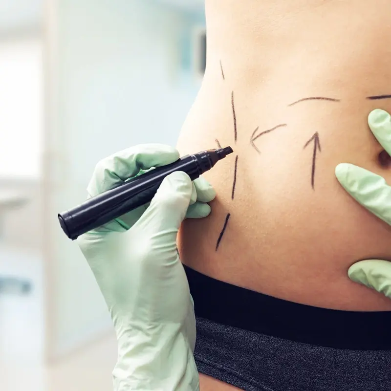 Liposuction