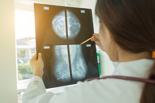 Benign Breast Disease