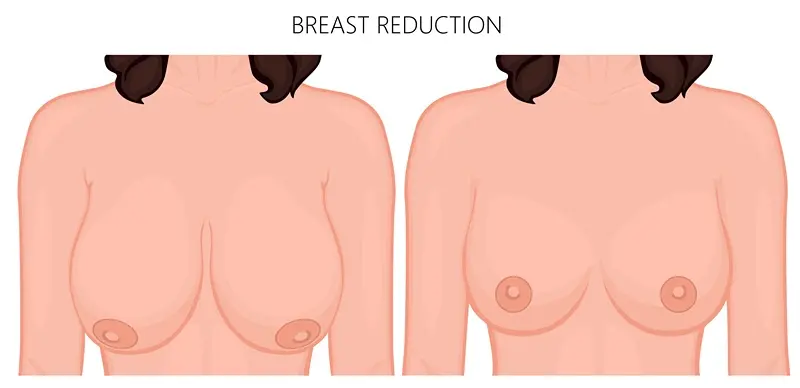 Breast Reduction