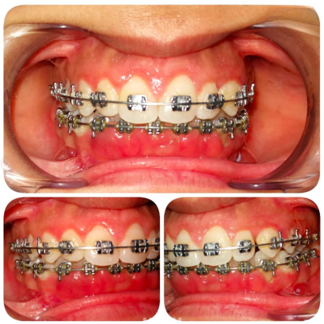 Ceramic and metal braces