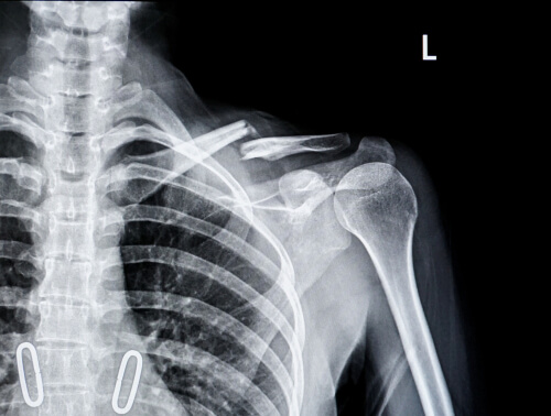 Clavicle fractures - DRHC Dubai Orthopedic Clinic