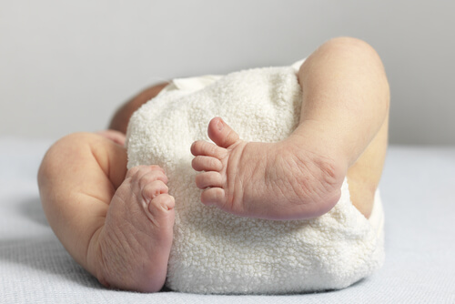 Clubfoot