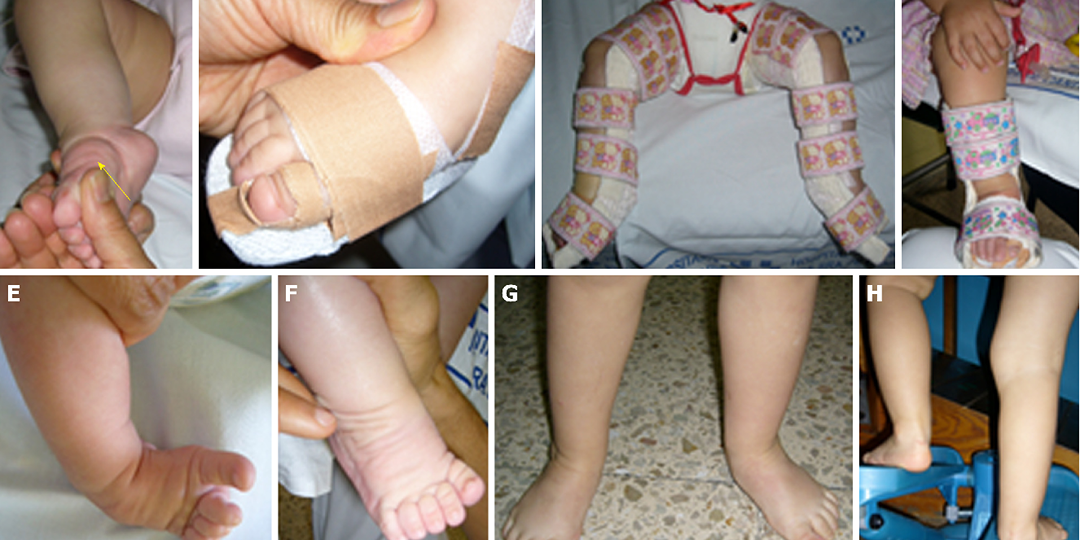 Clubfoot Treatment