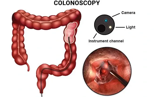 Colonoscopy Preparation: What to Eat and How to Take the Bowel Prep