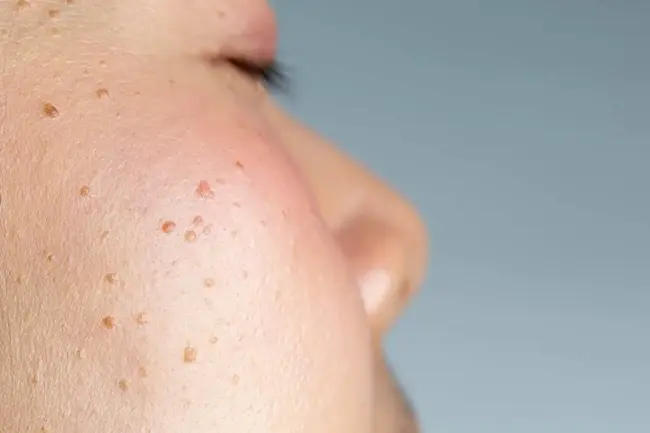 Cryotherapy for Seborrheic Keratosis: Safe Removal of Benign Skin Growths
