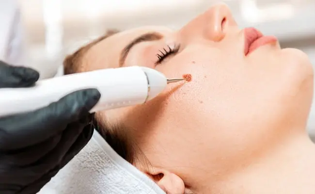 Cryotherapy for Skin Tags in Dubai: Safe Removal, Healing & Success Rates