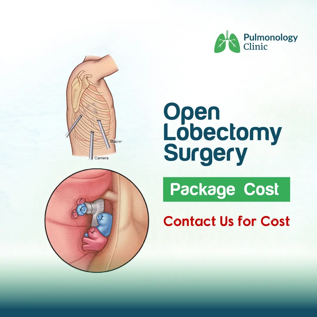 Open Lobectomy Surgery Open Lobectomy Surgery