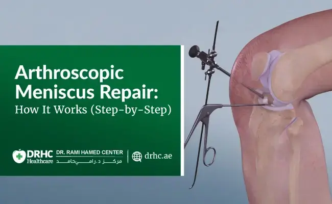 Arthroscopic Meniscus Repair: How It Works (Step-by-Step)