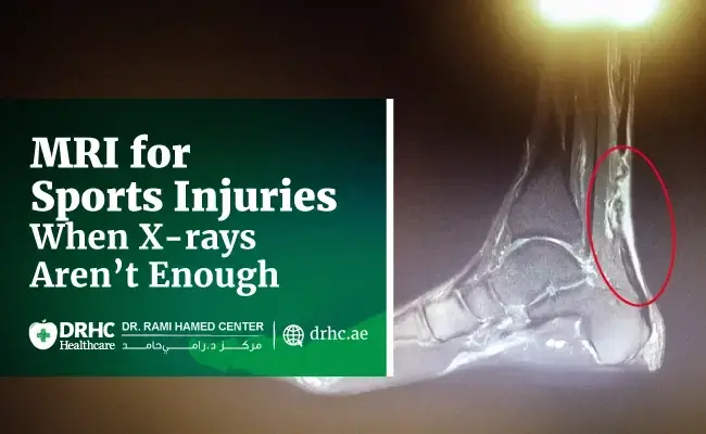 MRI for Sports Injuries – When X-rays Aren’t Enough