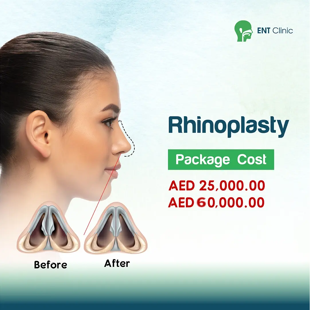 Rhinoplasty