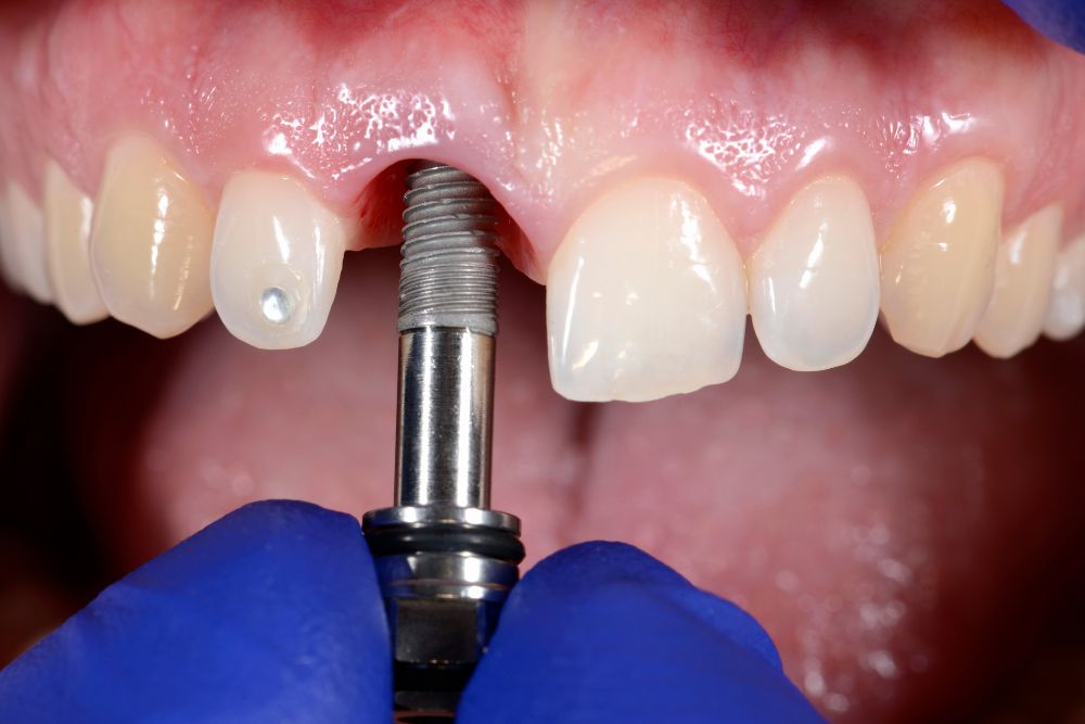 Dental Bonegraft