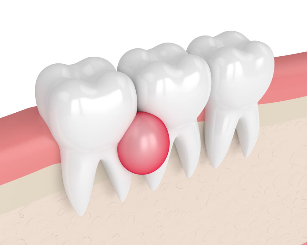 Dental Cyst removal in dubai