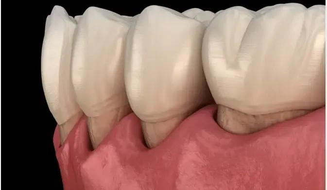 Dentine Hypersensitivity
