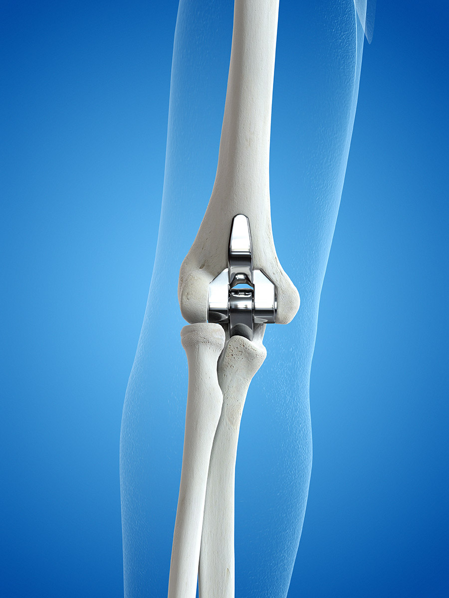 Elbow-Joint-Replacement