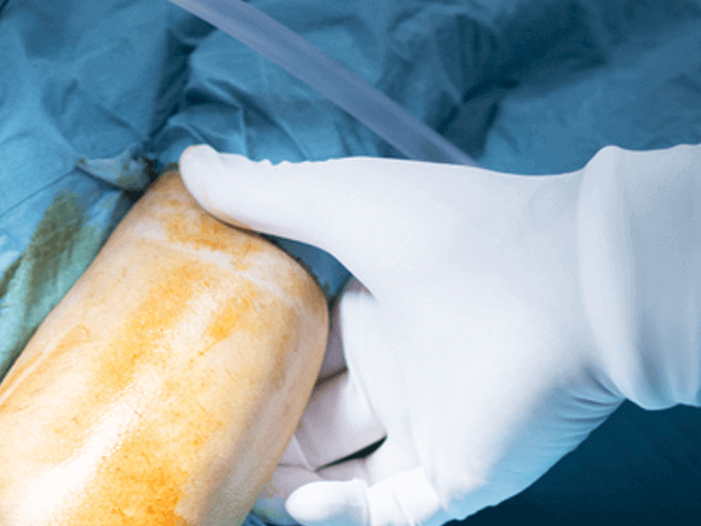 Elbow Arthroscopy