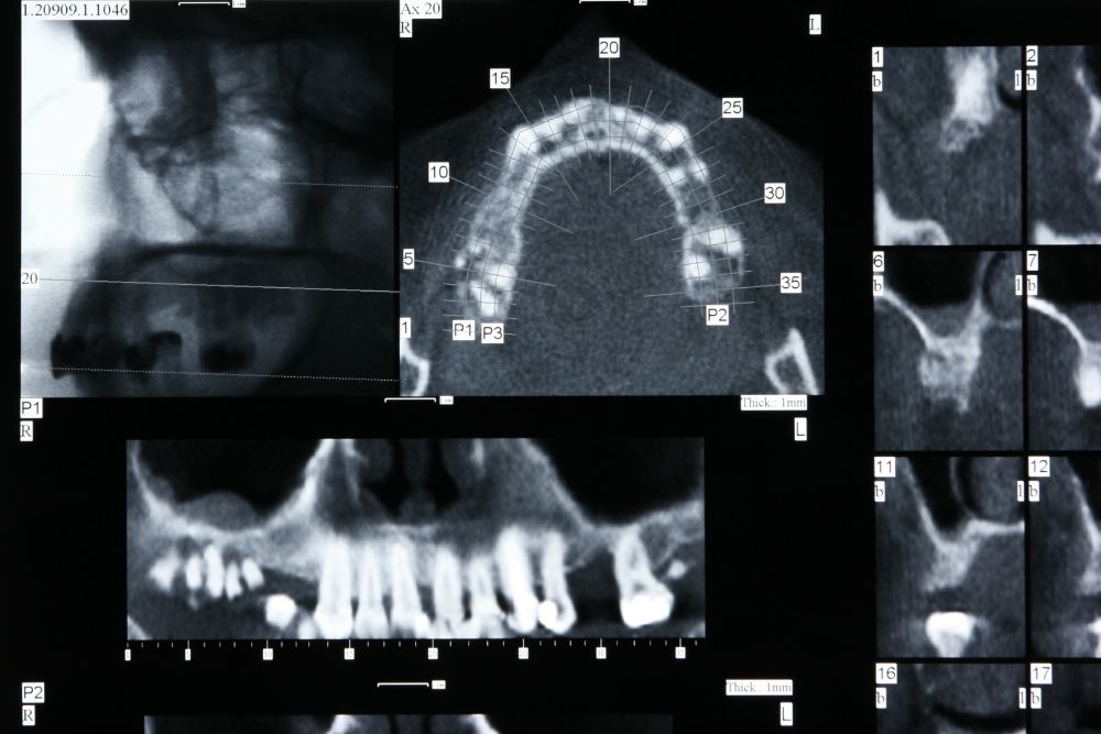 Facial Fracture or Trauma Surgery