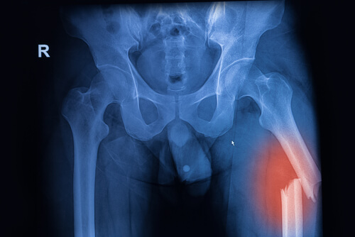 Femur fractures  DRHC Dubai Fracture Clinic