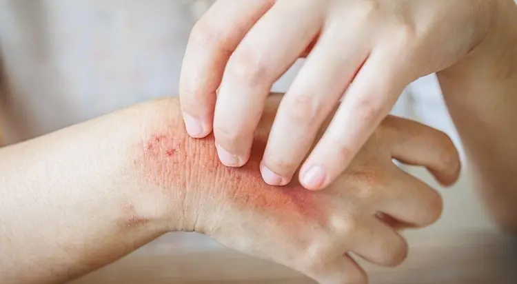 Fungal Infections Treatment Dubai