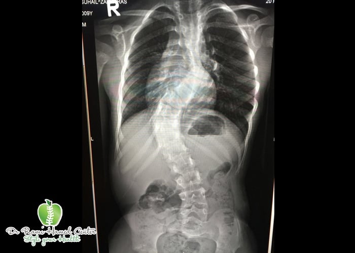 Dubai Spinal Surgery