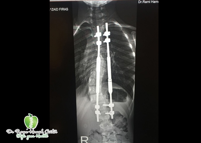 Dubai Spinal Surgery