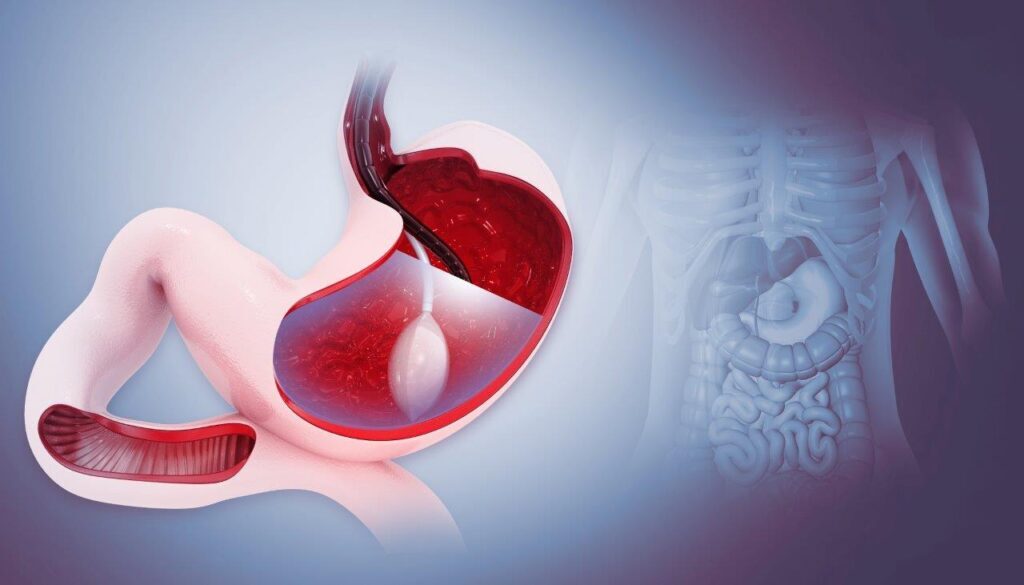 Gastric Balloon vs Weight-Loss Injections: Which May Suit You Better?