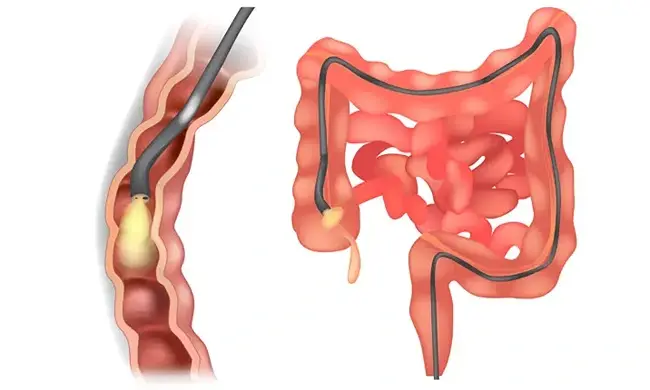 Gastroscopy With Biopsy: Why Does the Doctor Take a Tissue Sample?