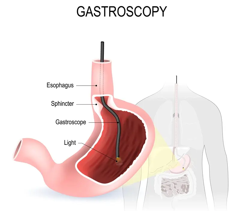 Gastroscopy