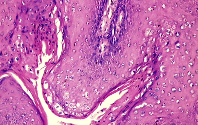 Giant Condyloma