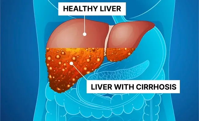 Grade 3 Fatty Liver: Does It Mean Cirrhosis?