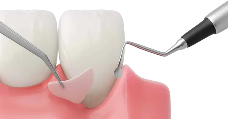 Gum Grafting Surgery