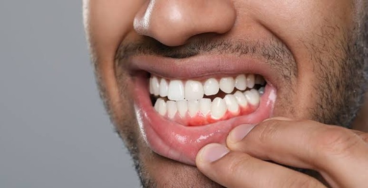 Gum Recession Treatment