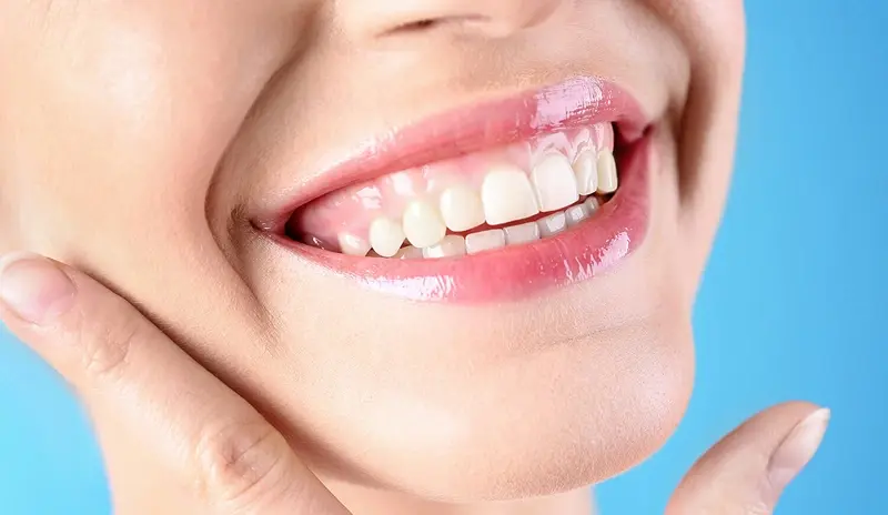 Gummy smile treatment