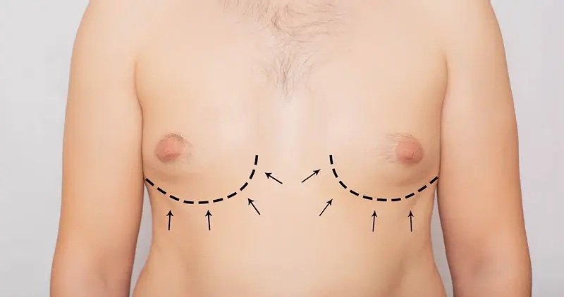 Gynecomastia
