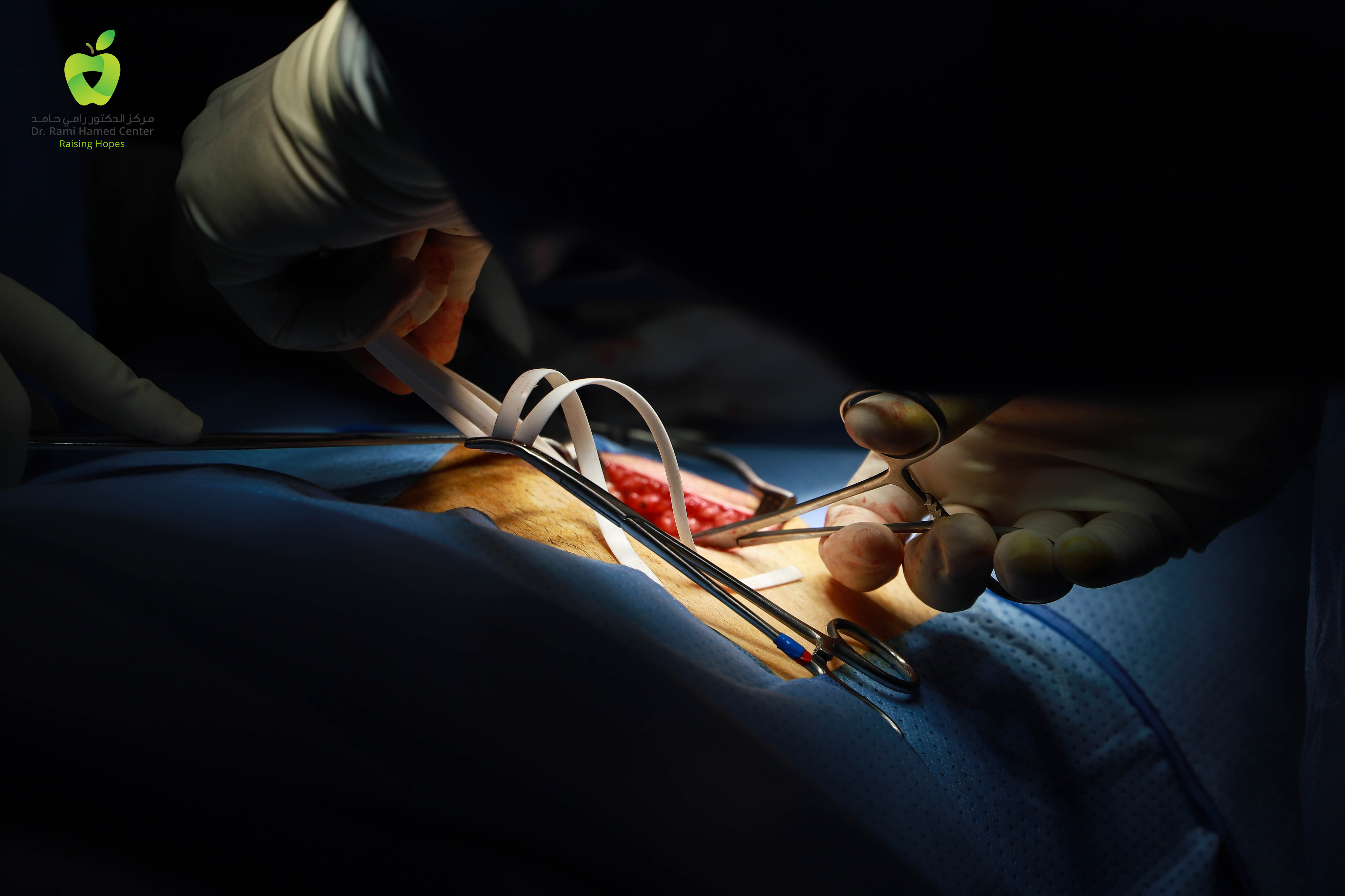 Dubai Hernia Surgery Clinic Incisional Hernia