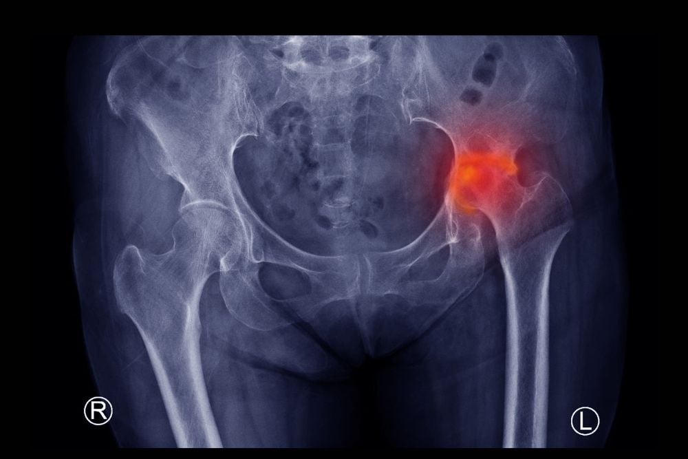 Hip Surgery