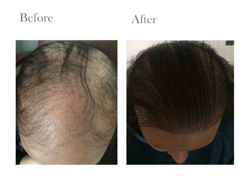 Hair Transplant clinic