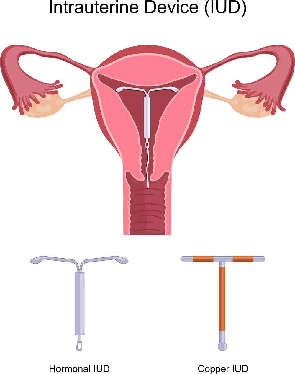 IUD Insertion