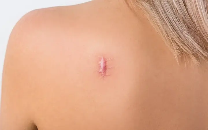 Keloid & Hypertrophic Scar Treatment Dubai