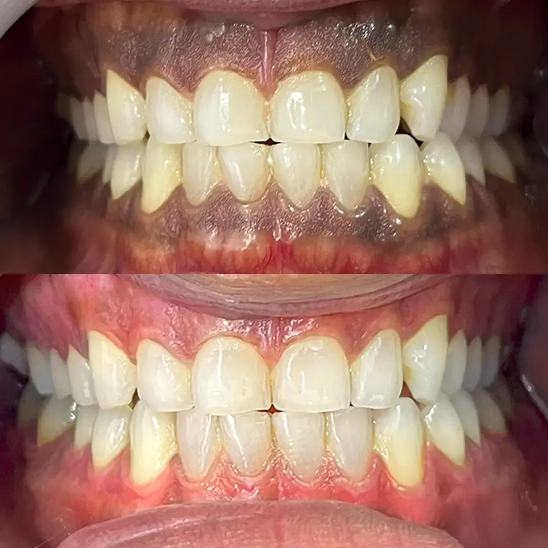Laser Depigmentation Before & After