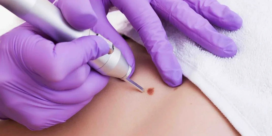 Laser Genital Wart Removal