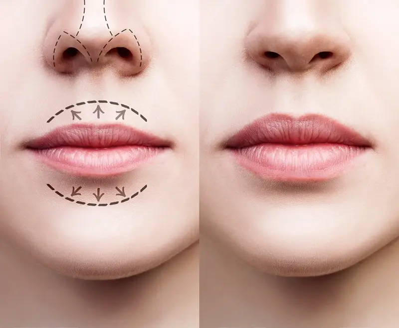 Lip Augmentation