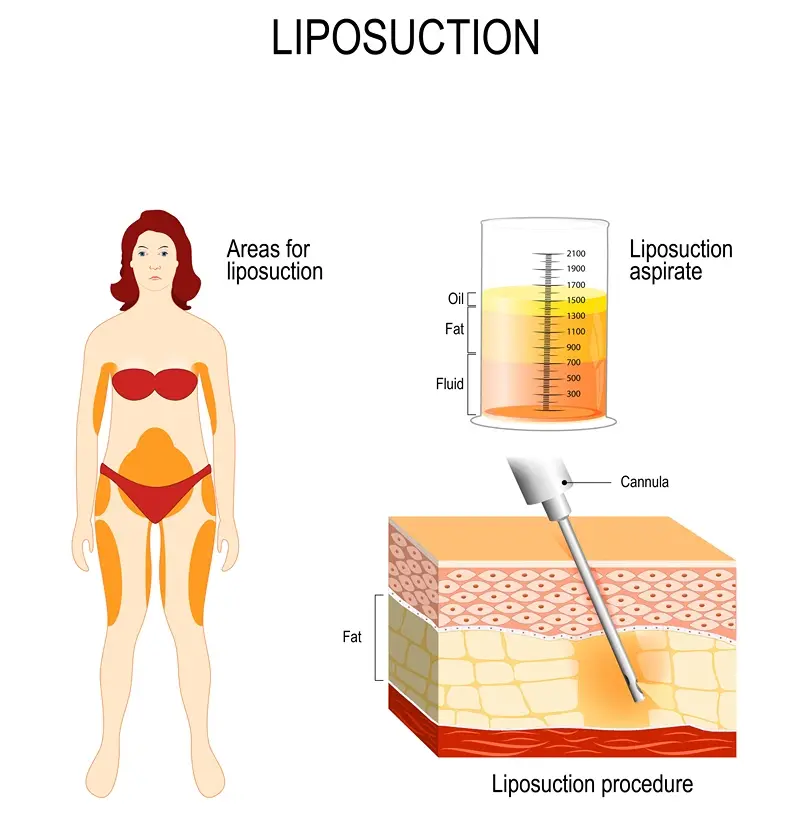 Liposuction