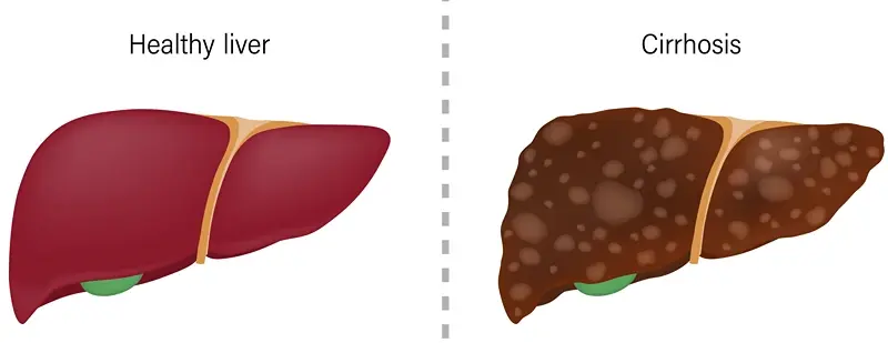 Liver Cirrhosis