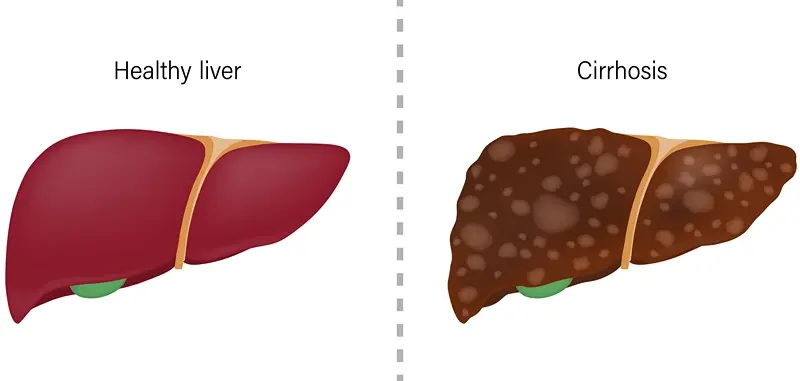 Liver Cirrhosis | Dubai Hepatology Clinic