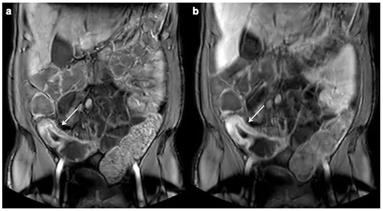 MRI Enterography