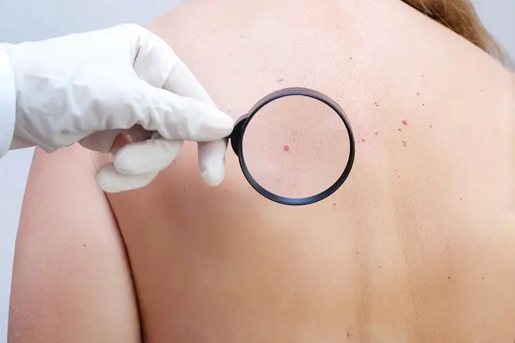 Melanoma Detection & Treatment in Dubai